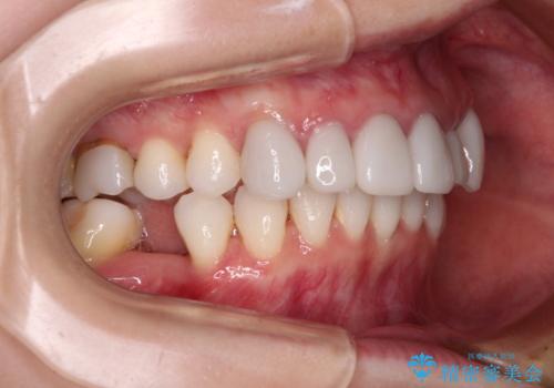 気にしていた歯並びをインビザラインで改善 セラミックも作り替えて綺麗な口元にの治療中