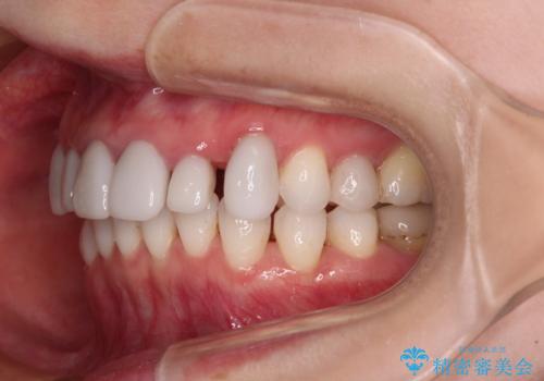 気にしていた歯並びをインビザラインで改善 セラミックも作り替えて綺麗な口元にの治療中