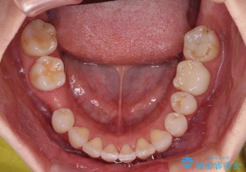 気にしていた歯並びをインビザラインで改善　セラミックも作り替えて綺麗な口元にの治療中