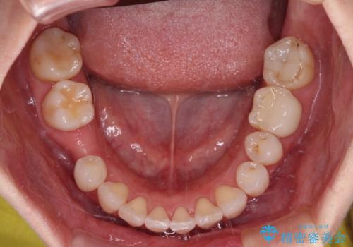 気にしていた歯並びをインビザラインで改善 セラミックも作り替えて綺麗な口元にの治療中