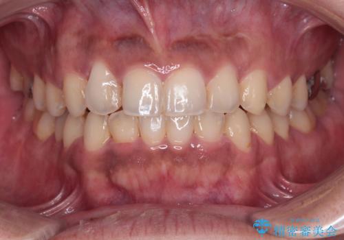 デコボコを治したい インビザラインによる矯正治療