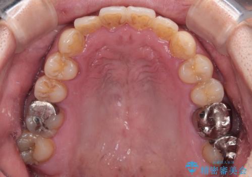デコボコを治したい インビザラインによる矯正治療の治療後