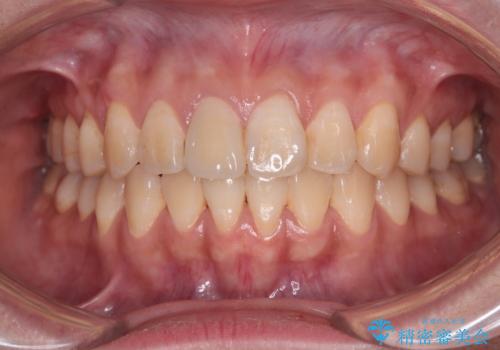 舌の突出癖による開咬と前歯の突出　インビザライン矯正治療