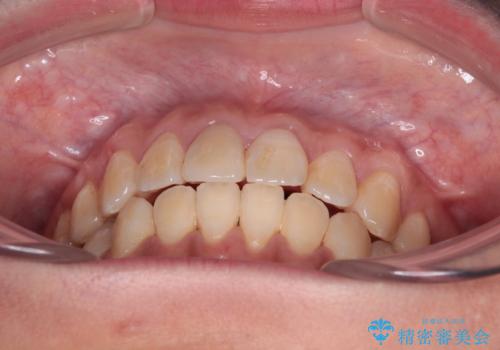 舌の突出癖による開咬と前歯の突出 インビザライン矯正治療の治療後