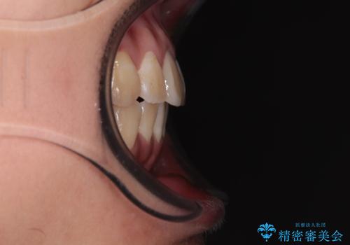 舌の突出癖による開咬と前歯の突出 インビザライン矯正治療の治療後