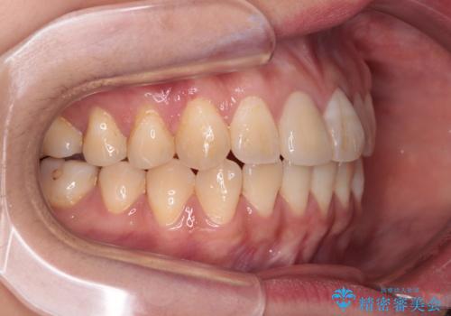 舌の突出癖による開咬と前歯の突出 インビザライン矯正治療の治療後