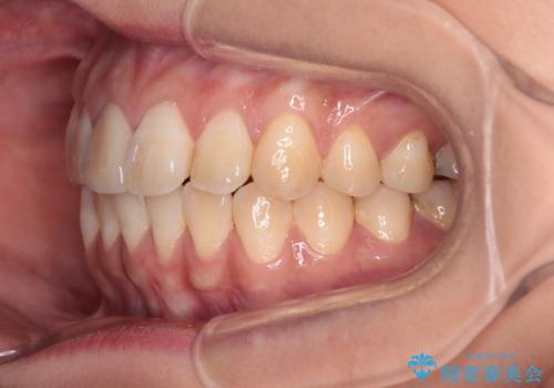 舌の突出癖による開咬と前歯の突出 インビザライン矯正治療の治療後