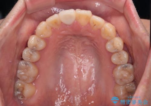 舌の突出癖による開咬と前歯の突出 インビザライン矯正治療の治療後