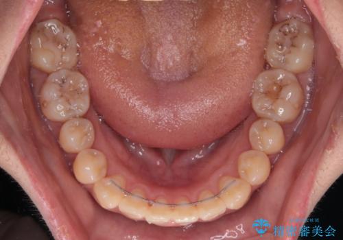 舌の突出癖による開咬と前歯の突出 インビザライン矯正治療の治療後