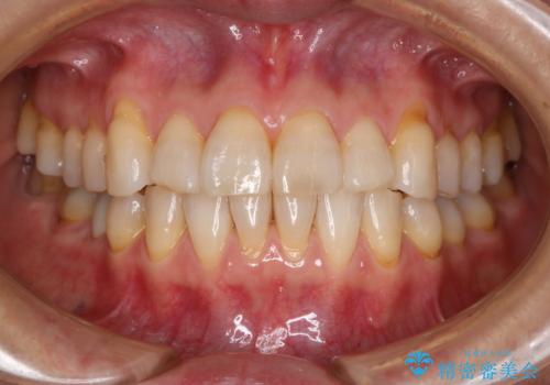 前歯の反対咬合、奥に引っ込んでしまっている歯をインビザラインで治療するの治療後