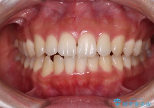 閉じにくい口元をワイヤー抜歯矯正でスッキリした口元にの症例 治療前