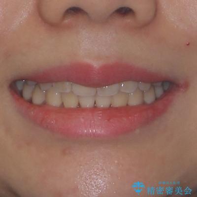 舌の突出癖による開咬と前歯の突出 インビザライン矯正治療の治療後(顔貌)