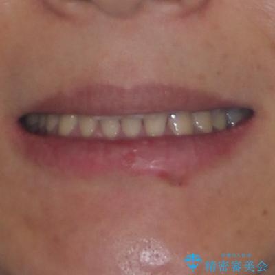 インビザラインが続けられない 忍耐のマウスピース矯正の治療後(顔貌)