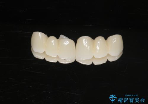 前歯が気になる。ブリッジによる治療。の治療中