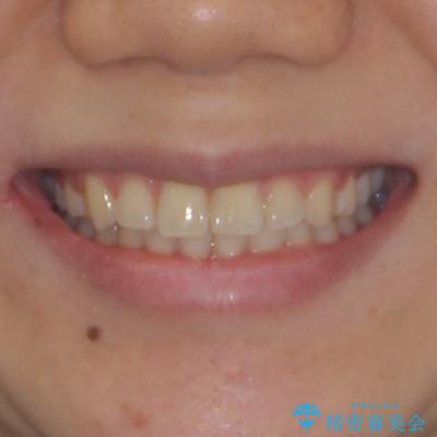 八重歯を治す 非抜歯のワイヤー矯正治療の治療後(顔貌)