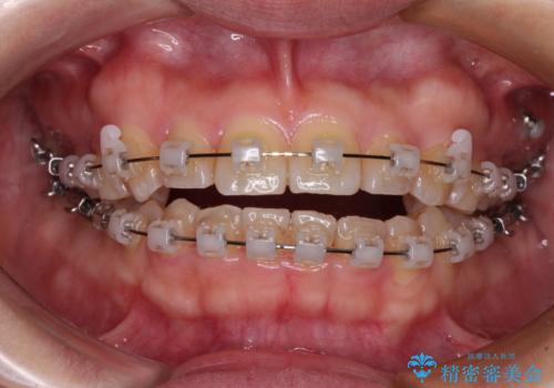 八重歯を治す 非抜歯のワイヤー矯正治療の治療中