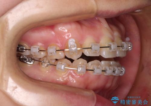 八重歯を治す 非抜歯のワイヤー矯正治療の治療中