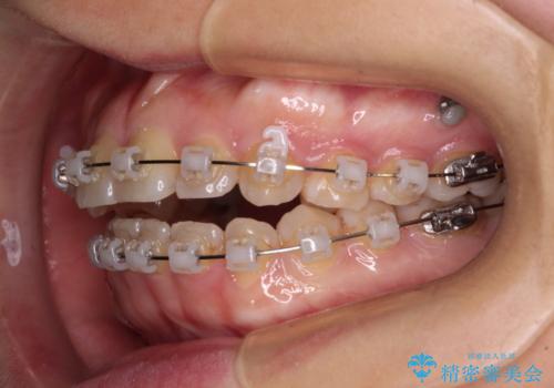 八重歯を治す 非抜歯のワイヤー矯正治療の治療中