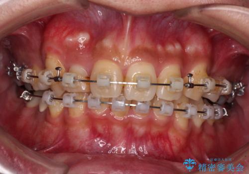 【モニター】八重歯と正中のずれた歯列　片顎抜歯のワイヤー矯正の治療中