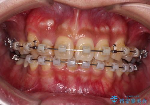 【モニター】八重歯と正中のずれた歯列 片顎抜歯のワイヤー矯正の治療中