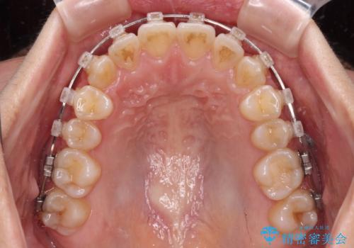 八重歯を治す　非抜歯のワイヤー矯正治療の治療中