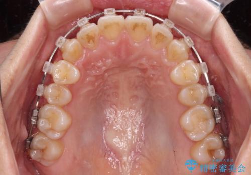 八重歯を治す 非抜歯のワイヤー矯正治療の治療中