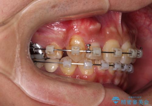 【モニター】八重歯と正中のずれた歯列　片顎抜歯のワイヤー矯正の治療中