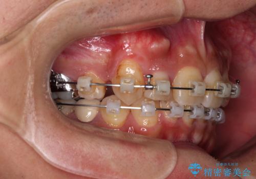 【モニター】八重歯と正中のずれた歯列 片顎抜歯のワイヤー矯正の治療中