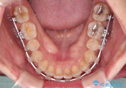 八重歯を治す 非抜歯のワイヤー矯正治療の治療中