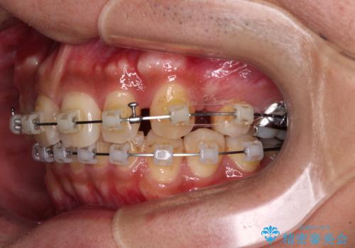 【モニター】八重歯と正中のずれた歯列　片顎抜歯のワイヤー矯正の治療中