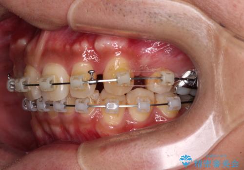 【モニター】八重歯と正中のずれた歯列 片顎抜歯のワイヤー矯正の治療中