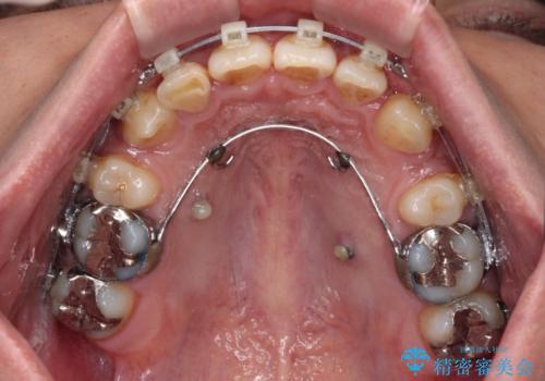 【モニター】八重歯と正中のずれた歯列　片顎抜歯のワイヤー矯正の治療中