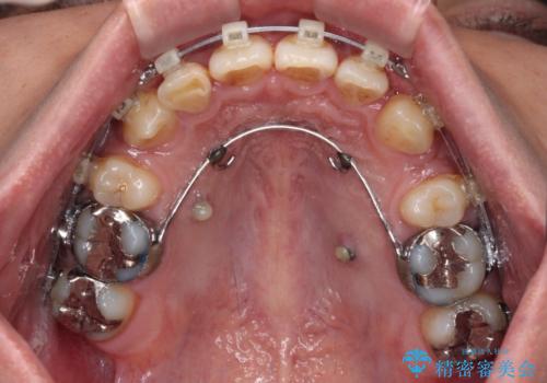 【モニター】八重歯と正中のずれた歯列 片顎抜歯のワイヤー矯正の治療中