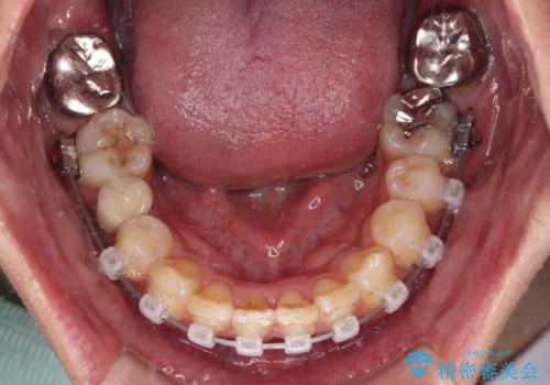 【モニター】八重歯と正中のずれた歯列 片顎抜歯のワイヤー矯正の治療中