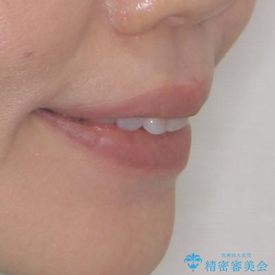 前方に飛び出した前歯 ワイヤー装置での抜歯矯正の治療前(顔貌)