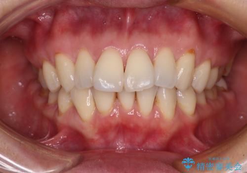 前方に飛び出した前歯 ワイヤー装置での抜歯矯正の症例 治療前