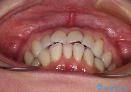 前方に飛び出した前歯 ワイヤー装置での抜歯矯正の治療前