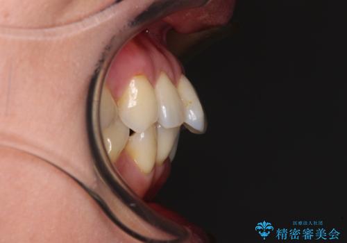 前方に飛び出した前歯 ワイヤー装置での抜歯矯正の治療前