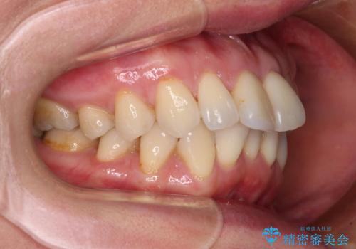 前方に飛び出した前歯 ワイヤー装置での抜歯矯正の治療前