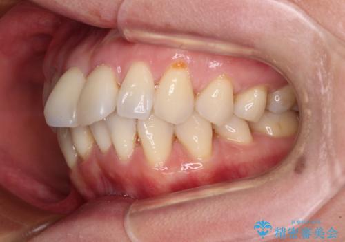 前方に飛び出した前歯 ワイヤー装置での抜歯矯正の治療前