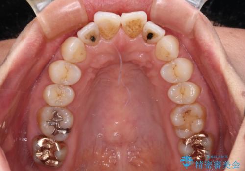 前方に飛び出した前歯 ワイヤー装置での抜歯矯正の治療前