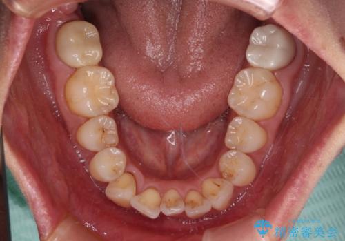 前方に飛び出した前歯 ワイヤー装置での抜歯矯正の治療前
