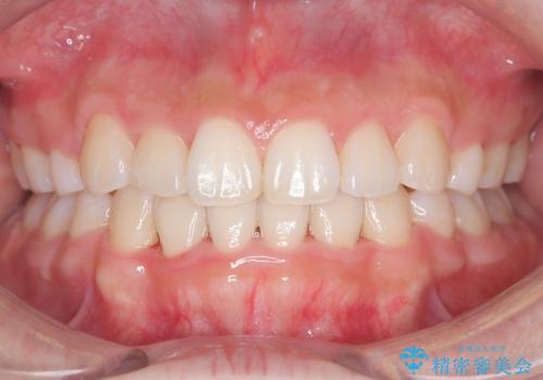 八重歯を改善!美しい口元を実現するハーフリンガル矯正の症例 治療後