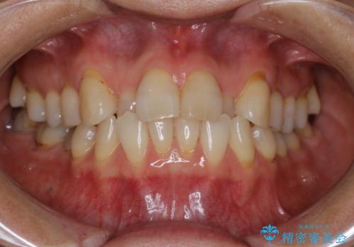 前歯の反対咬合、奥に引っ込んでしまっている歯をインビザラインで治療する