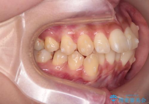 反対咬合を治したい。インビザラインの治療中