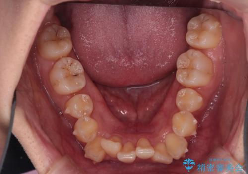 反対咬合を治したい。インビザラインの治療中