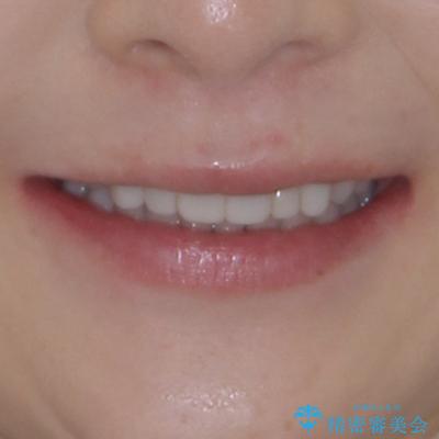 気にしていた歯並びをインビザラインで改善 セラミックも作り替えて綺麗な口元にの治療後(顔貌)