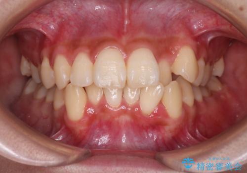 反対咬合を治したい。インビザラインの症例 治療前