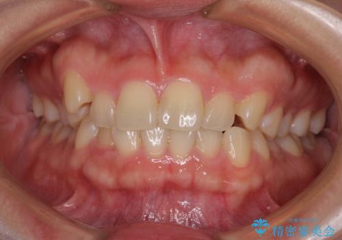 八重歯を治す　非抜歯のワイヤー矯正治療の症例 治療前
