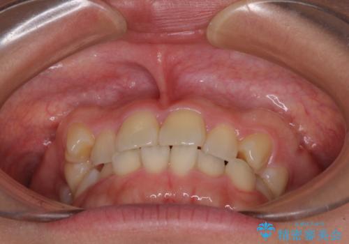 八重歯を治す 非抜歯のワイヤー矯正治療の治療前